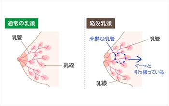 通常の乳頭と陥没乳頭の比較