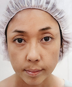 ハムラ法 施術前