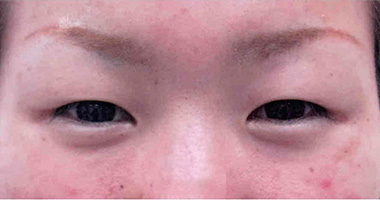 マイクロカット法 施術前