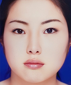 ミニマムカット法 施術後