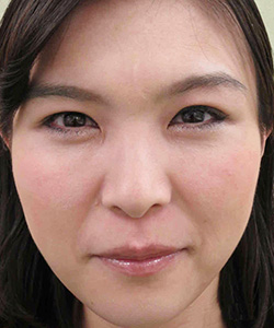 ミニマムカット法 施術後