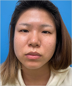 眼瞼下垂 施術前