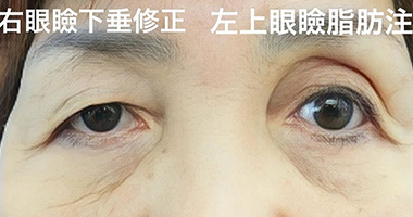 上眼瞼脂肪注入 施術前