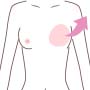 人工乳腺抜去