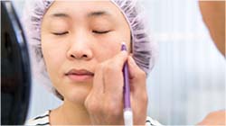 施術場所にマーキングする