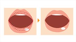 粘膜部分を切開する